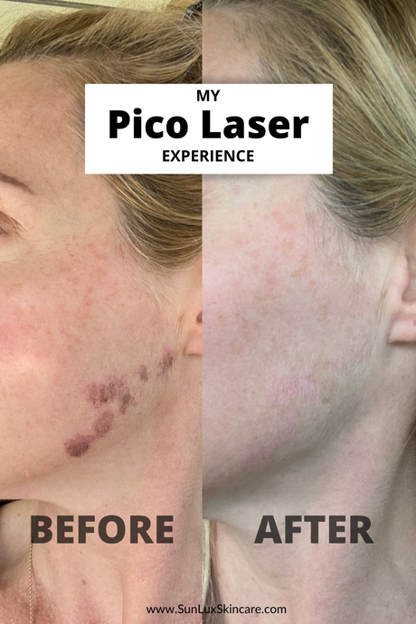 The Good & Bad of Pico Laser Treatment
